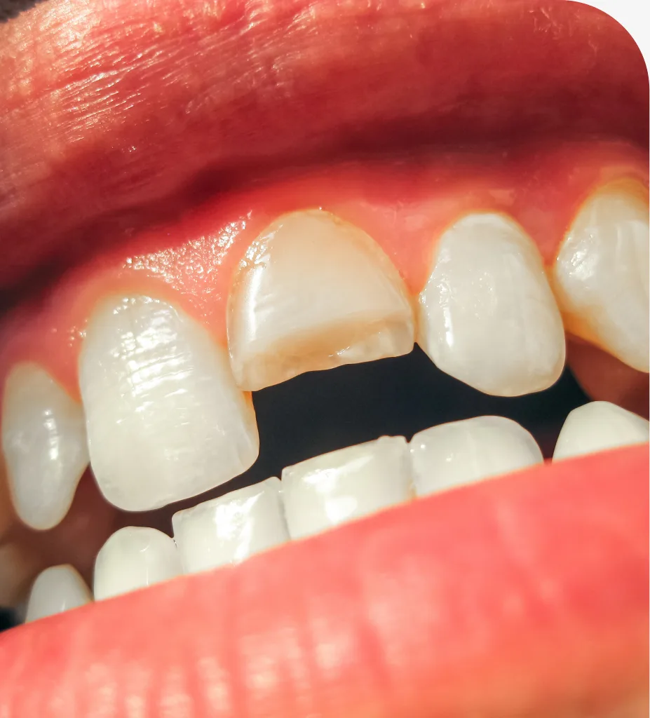 Composite Dental Fillings at Centro Dental Las Americas