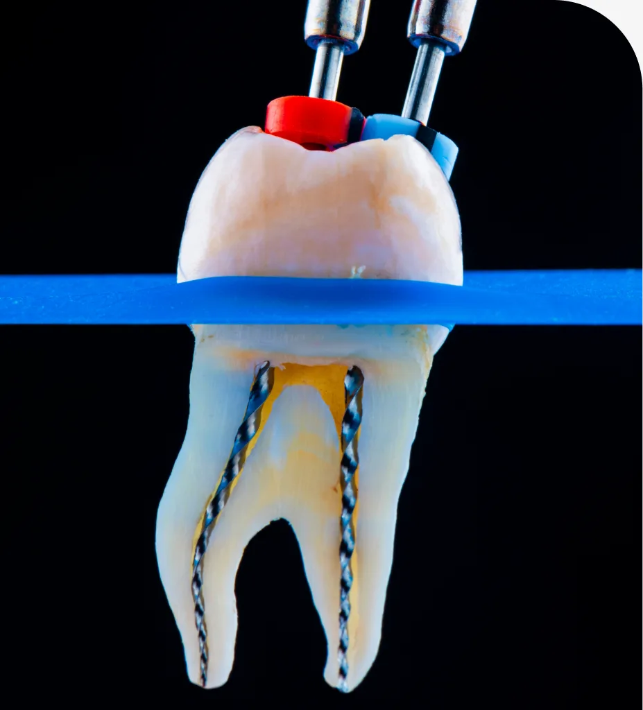 Root Canal Therapy at Centro Dental Las Americas